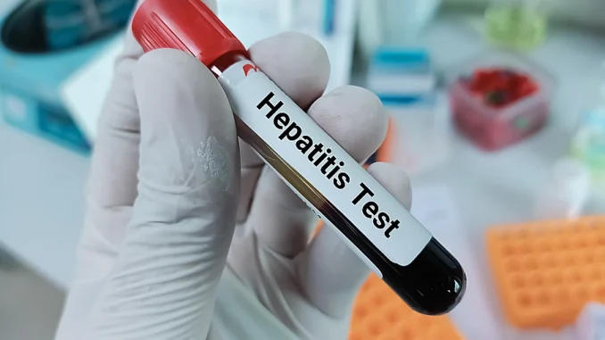 žloutenka typu A